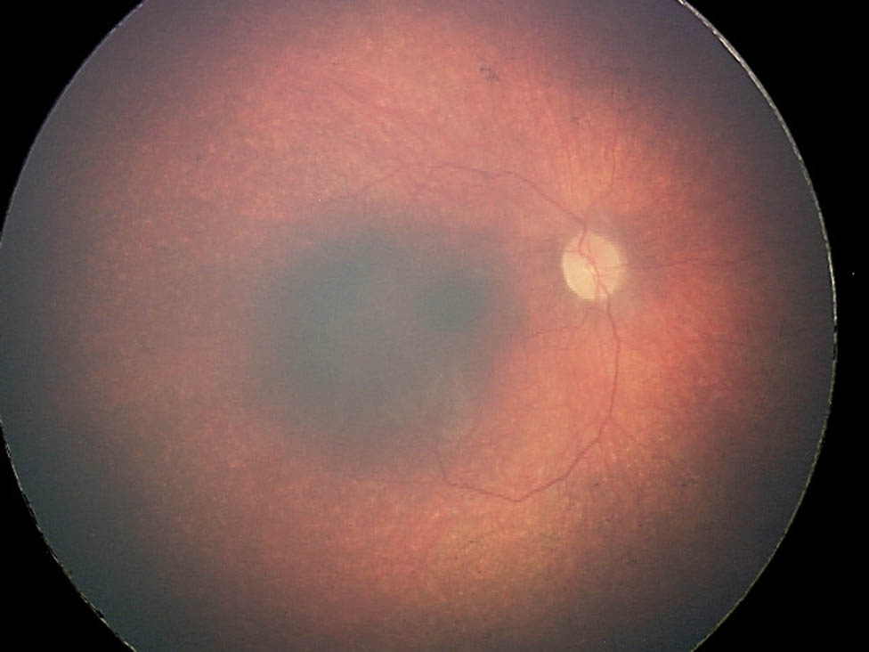 Figure 4 
               Right fundus photography of a girl with Cohen syndrome – note eyes pale optic discs and “salt and pepper” retinopathy.
            