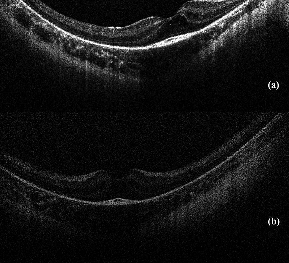 Figure 5 
               (a) and (b) Results of optical coherence tomography – macular edema in both eyes.
            