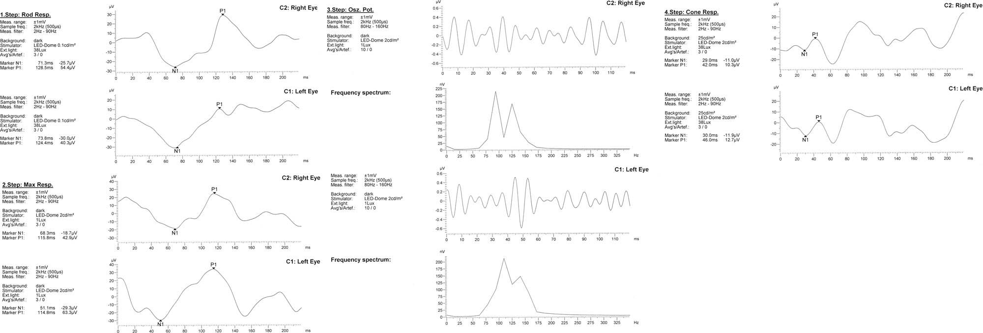 Figure 6 
               Electroretinography result.
            