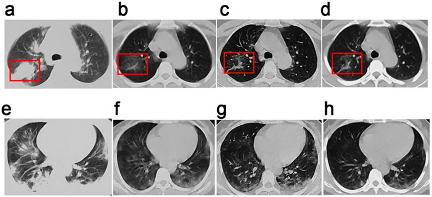 Figure 1
Chest CT images of a 41-year-old woman with SARS-CoV-2 infection. Chest CT images for a 41-year-old woman who presented at Changchun Infectious Diseases Hospital with fever and cough. (a–d) Images showing lesions in the posterior segment of the inferior lobe of the right lung. (a) Image taken at admission before the onset of treatment showing consolidated opacities in the right lung. (b and c) Images obtained on days 4 and 7 showing marked absorption of pulmonary consolidations. (d) Image taken on day 10 showing stripe-like opacities indicating recovery of the lung from infection. (e–h) Images of the lower lobe of the lung taken, (e), at the onset of treatment, (f), on day 4, (g), on day 7, and (h), on day 10, showing the infection and progressive treatment efficacy. Ground-glass opacities in the pulmonary pleural can be seen to reduce in the lower lobe of the lung from (e) to (h).