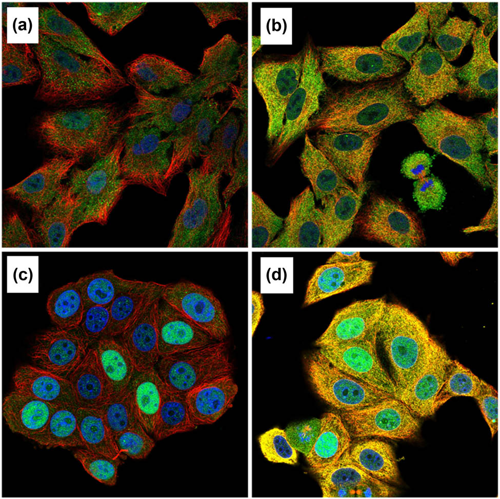 Figure 12 
                  KPNA2 protein was mainly localized to the nucleoplasm and cytosol in cancer cells with blue staining. (a) Immunofluorescent staining of human lung cancer cell line A549 shows localization to nucleoplasm in antibody + nucleus + microtubule channels. (b) Immunofluorescent staining of human lung cancer cell line A549 shows localization to nucleoplasm in antibody + nucleus + microtubule + ER channels. (c) Immunofluorescent staining of human breast cancer cell line MCF7 shows localization to nucleoplasm in antibody + nucleus + microtubule channels. (d) Immunofluorescent staining of human breast cancer cell line MCF7 shows localization to nucleoplasm in antibody + nucleus + microtubule + ER channels.
               