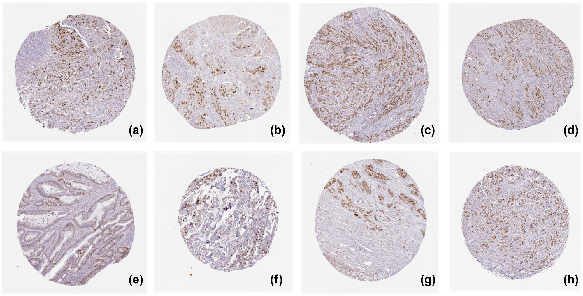 Figure 13 
                  KPNA2 protein positive expression in six major cancers detected by Immunohistochemistry assay. (a) Lung adenocarcinoma, (b) lung squamous cell carcinoma, (c) gastric cancer, (d) colon cancer, (e) rectal cancer, (f) breast cancer, (g) liver hepatic carcinoma, (h) bladder cancer.
               