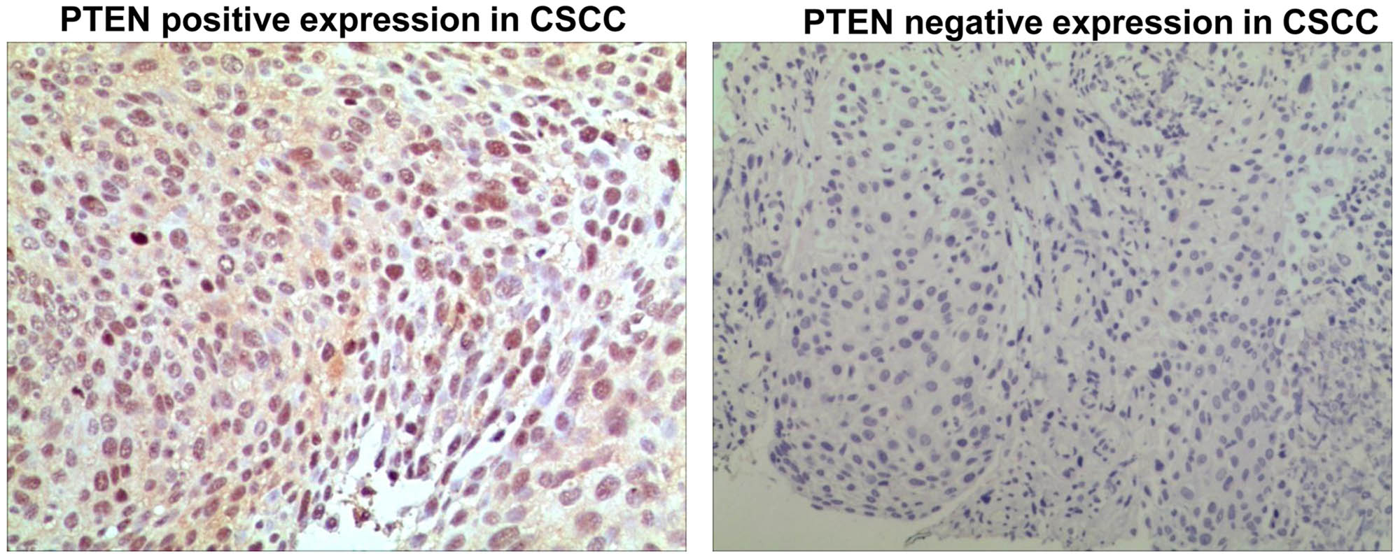Figure 2 
                  PTEN expression in CSCC. Magnification: ×10.
               