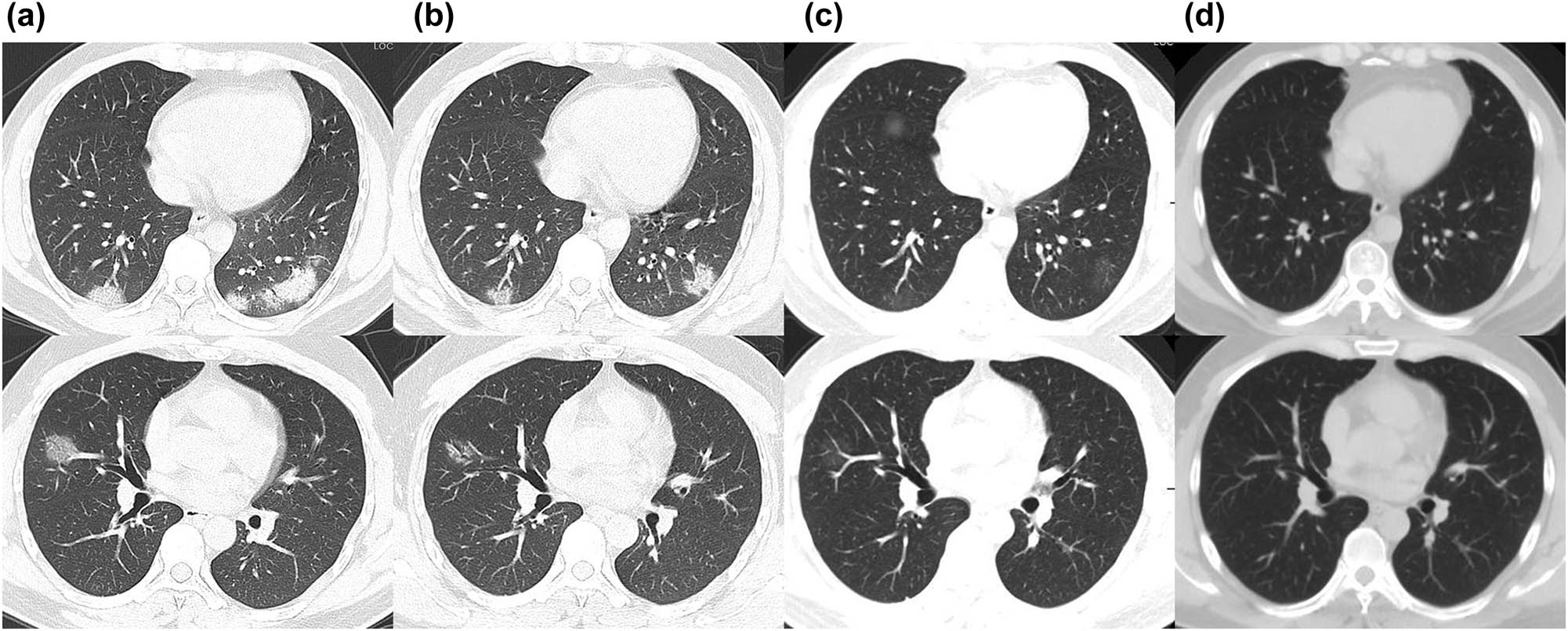 Figure 1 
               Chest CT images of the patient. (a) Multiple nodular and patchy high-density shadows on February 6; (b) Partial absorption of multiple nodular and patchy high-density shadows with ground-glass opacity on February 13; (c) Most absorbed with few parts of ground-glass opacity on March 5; (d) Normal CT image on April 29.
            