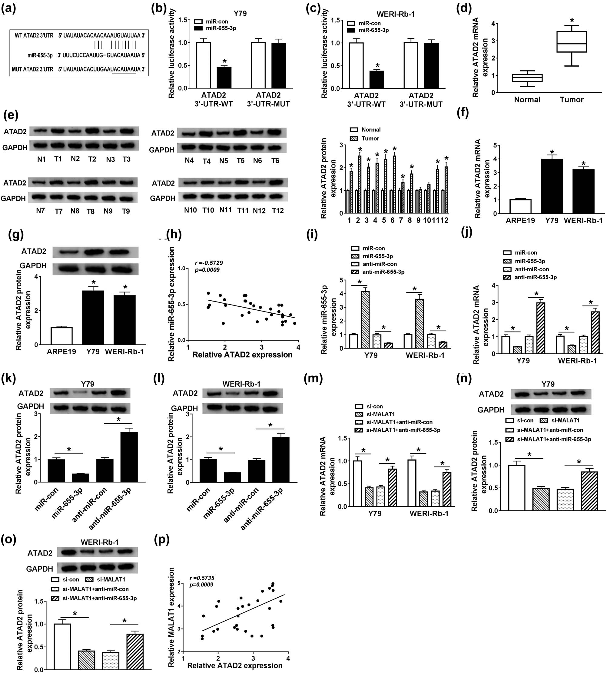 Figure 5 
                  MALAT1 upregulated ATAD2 expression by repressing miR-655-3p in Y79 and WERI-Rb-1 cells. (a) Putative or mutant binding sites of miR-655-3p in the ATAD2 3′-UTR were predicted by StarBase. (b and c) The luciferase activity of Y79 and WERI-Rb-1 cells co-transfected with WT-ATAD2 or MUT-ATAD2 and miR-655-3p or miR-con for 48 h was evaluated by dual-luciferase reporter assay. (d) The mRNA level of ATAD2 in RB and normal tissues was detected by RT-qPCR. (e) The protein levels of ATAD2 in 12 RB and normal tissues were exposed by western blot assay. (f and g) The mRNA and protein levels of ATAD2 in RB cells (Y79 and WERI-Rb-1) and retinal pigment epithelial cells ARPE19 were uncovered by RT-qPCR and western blot assay, respectively. (h) The correlation between miR-655-3p and ATAD2 was processed by Pearson’s correlation analysis. (i–l) Y79 and WERI-Rb-1 cells were co-transfected with miR-con, miR-655-3p, anti-miR-con, and anti-miR-655-3p. (i and j) After transfection for 24 h, the expressions of miR-665-3p and ATAD2 mRNA were detected by RT-qPCR. (k and l) After transfection for 48 h, the protein level of ATAD2 was examined by western blot. (m–o) Y79 and WERI-Rb-1 cells were transfected with si-con, si-MALAT1, si-MALAT1 + anti-miR-con, or si-MALAT1 + anti-miR-655-3p. After transfection for 24 or 48 h, the mRNA and protein levels of ATAD2 were measured via RT-qPCR and western blot assay. (p) The correlation between MALAT and ATAD2 was validated by Pearson’s correlation analysis. *P < 0.05.
               