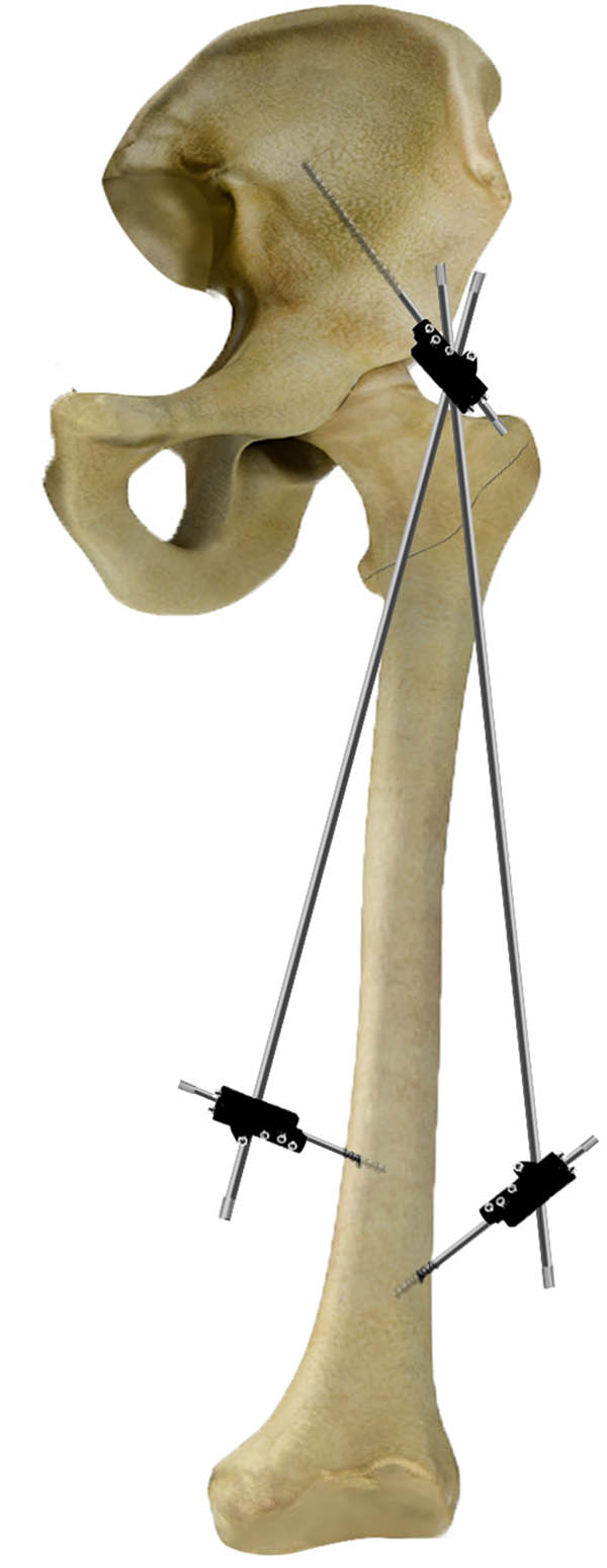 Figure 1
It illustrates the details of this novel external fixation method via the AIIS and distal femur.