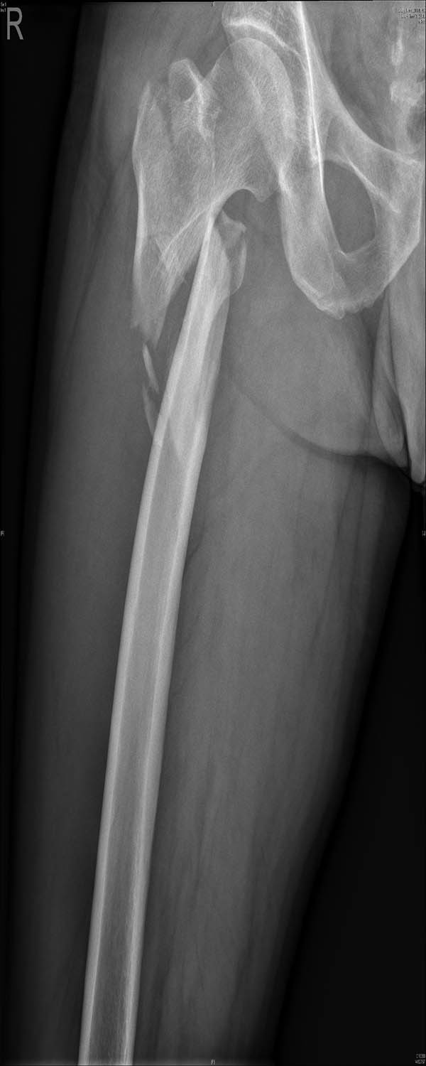 Figure 2
A 42-year-old man fell from height and his X-ray examination revealed that a femoral intertrochanteric fracture had occurred and that the fracture was displaced.