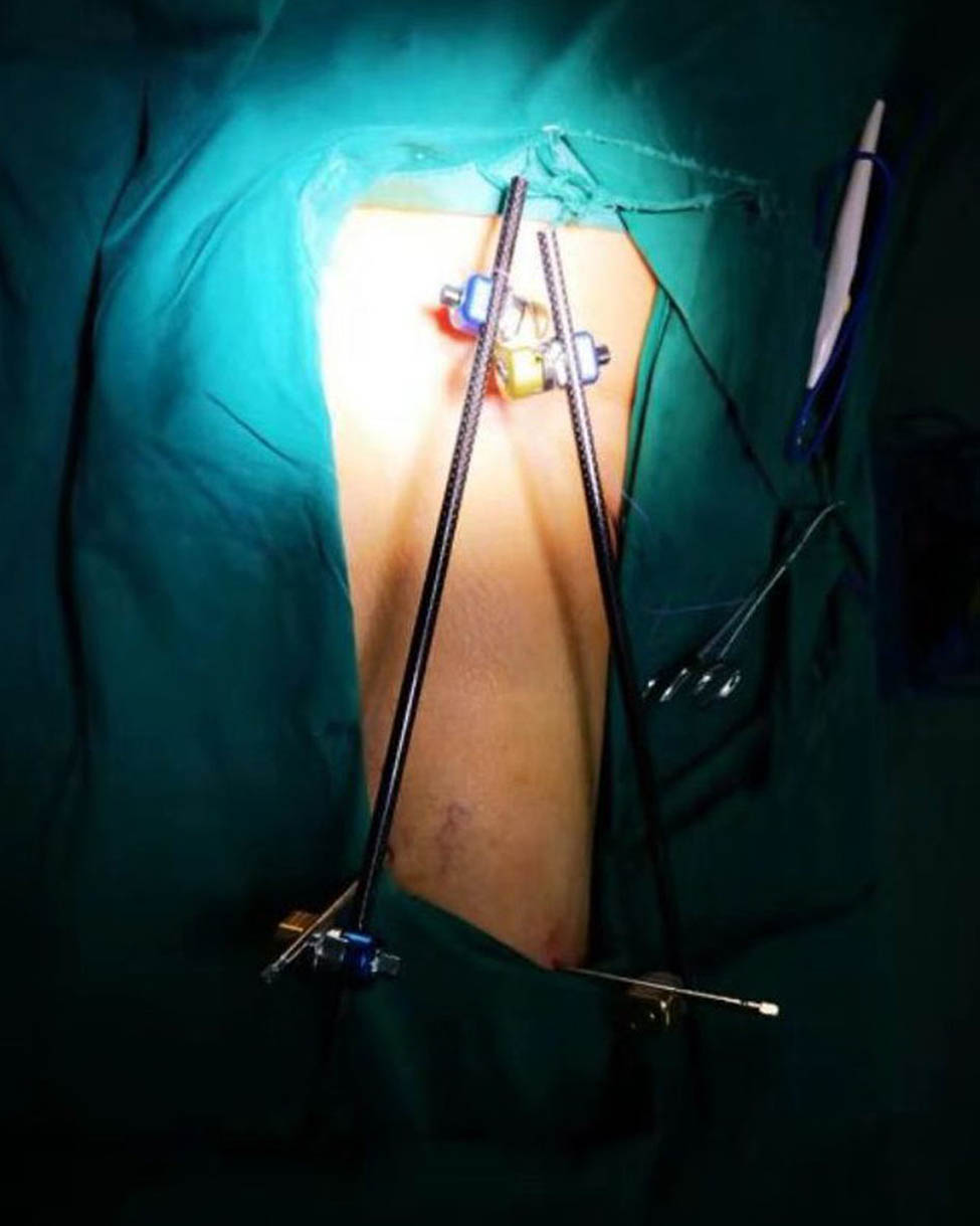 Figure 3
A patient with femoral intertrochanteric fracture was fitted with an external fixator during emergency surgery.