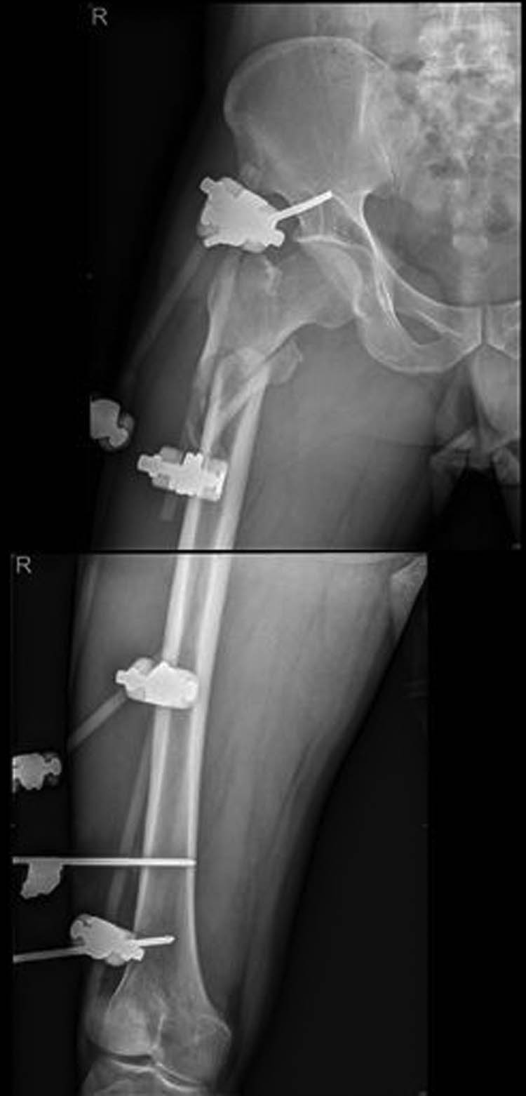 Figure 4
Postoperative X-ray showing good alignment following external fixation.