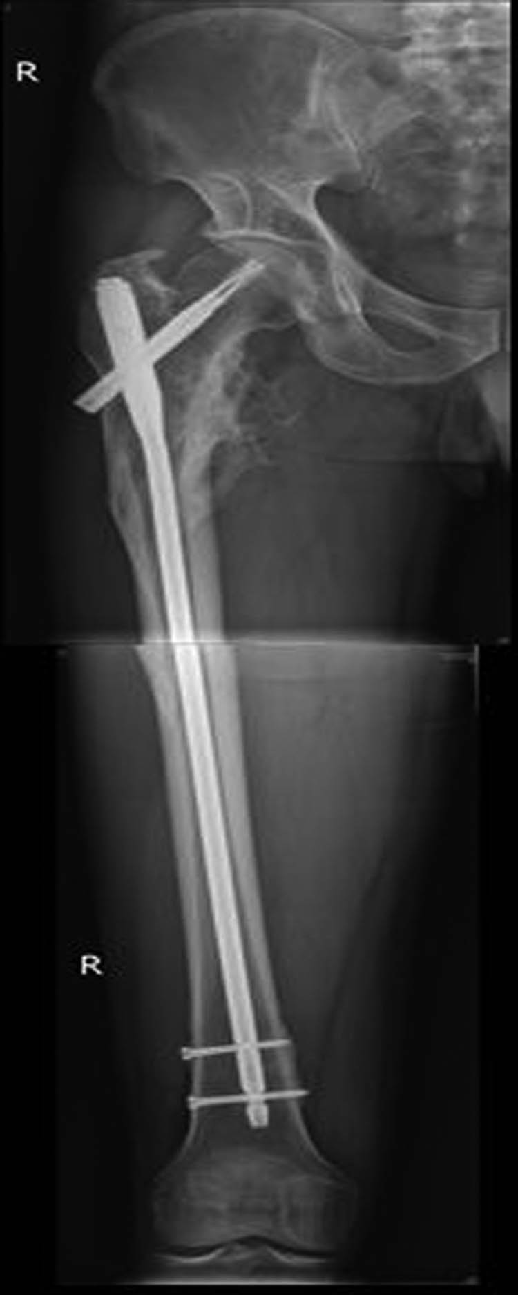 Figure 5
Patient with femoral intertrochanteric fracture accepted intramedullary nailing and the fracture eventually healed.