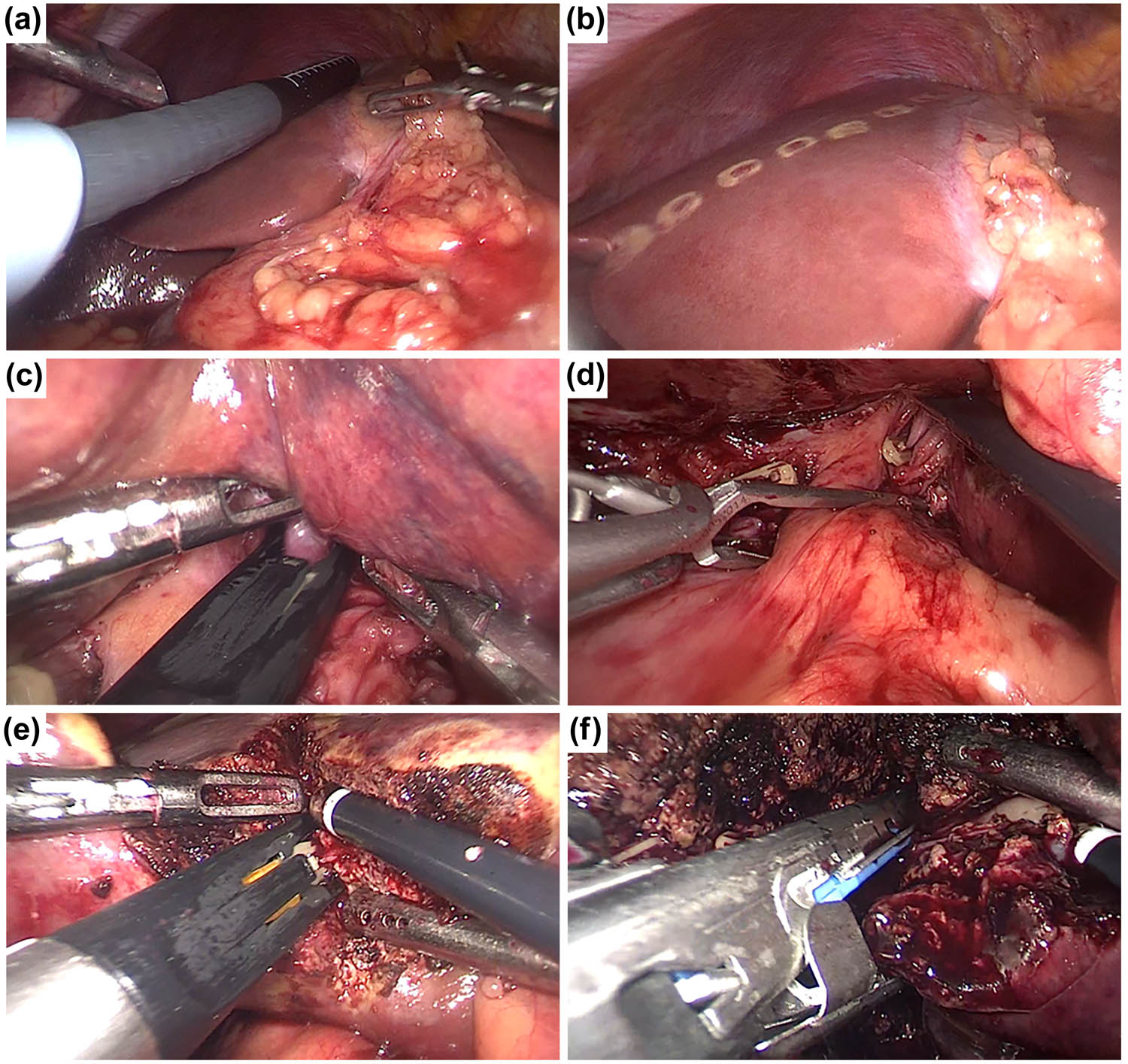 Figure 1 
                  Surgical techniques for LMH. (a and b) intraoperative ultrasonography is used routinely and the hepatic transection line was marked. (c and d) The Glissonean approach is used to control the liver inflow. (e and f) The left portal vein and hepatic artery are isolated and divided by Hem-o-lock clips and/or Endo-GIA device.
               