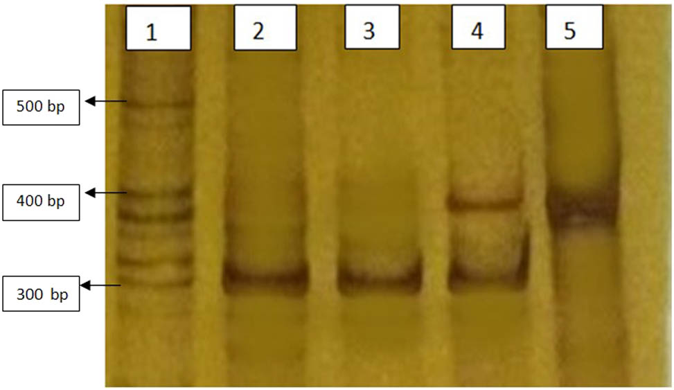 Figure 2
Silver stained polyacrylamide gel electrophoresis showing different transcripts of BCR–ABL after RT-PCR with e12a2 primer. All lanes are positive for BCR–ABL mutation typical p210 kDa (e13a2 and/or e14a2) transcripts. Lane 1 shows ladder (molecular weight marker) of various size fragments. bp (base pair). Lanes 2 and 3 are from chronic phase CML patients expressing 310 bp fragment of e13a2 BCR–ABL. Lane 4 is from a chronic phase CML patient co expressing both e13a2 and e14a2 BCR–ABL. Lane 5 is from a chronic phase CML patient expressing 385 bp fragment of e14a2 BCR–ABL.