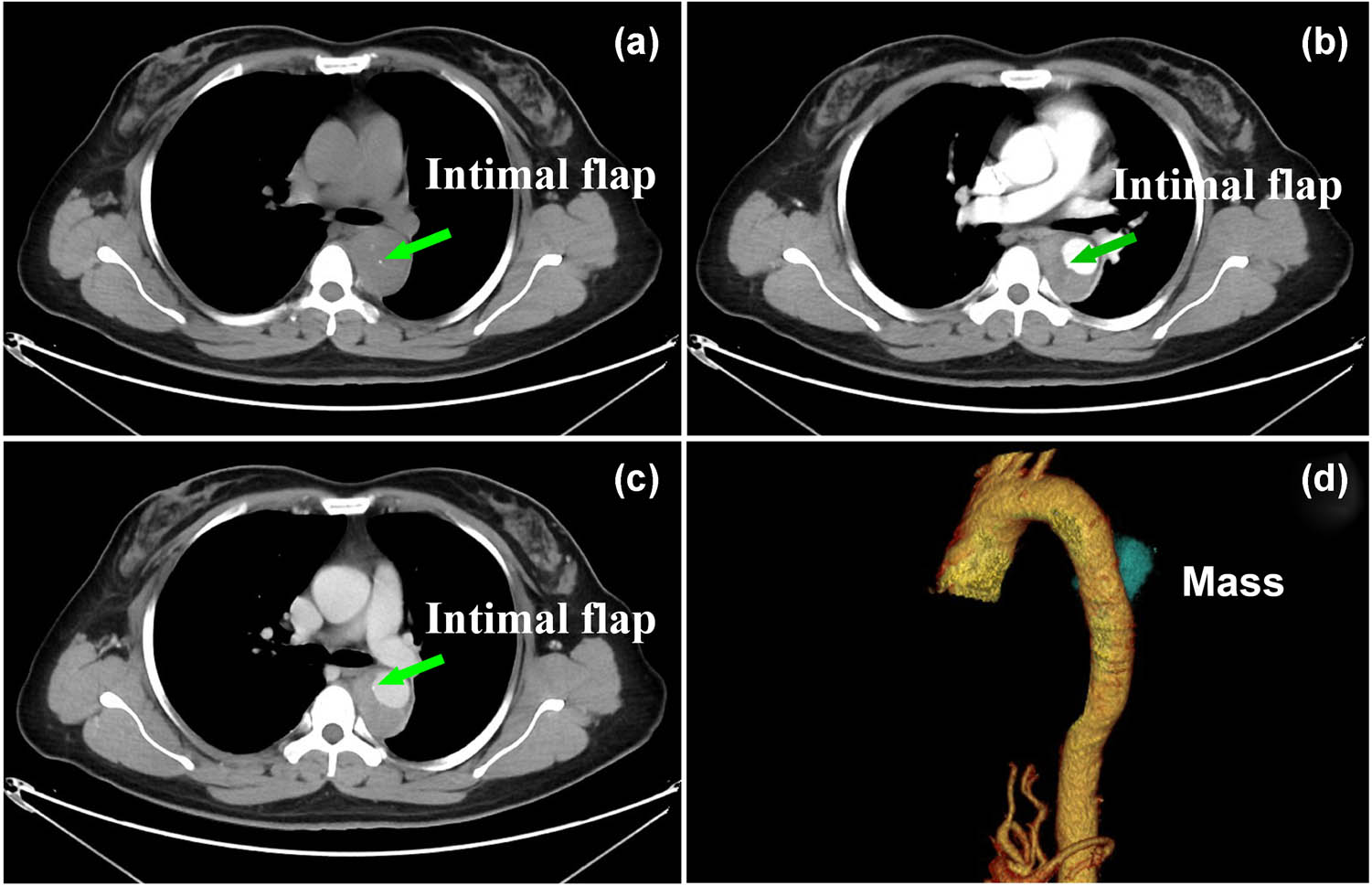 Figure 1 
               Axial nonenhanced CT images (a) showing a crescent-shaped thickening of aortic wall with the same attenuation as that of the lumen and intimal flap. CTA (c and d) showing an intimal flap and expanded false lumen with slight enhancement, and correspond reconstructed image (d) showing a mass-like false lumen, which was interpreted by radiologists as IMH.
            