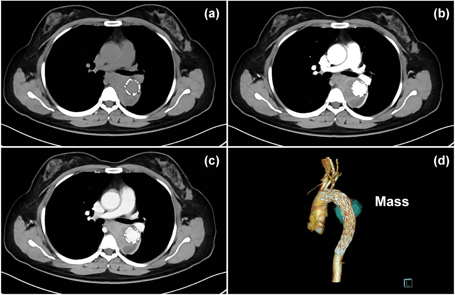 Figure 3 
               Axial nonenhanced CT image (a) and CTA (b–d) showing enlargement of the false lumen three months after stent implantation, with nonhomogeneous enhancement and mediastinal extensions of the false lumen, which was interpreted by radiologists in our hospital and other medical centers during follow-up as an endoleak and periaortic hematoma.
            