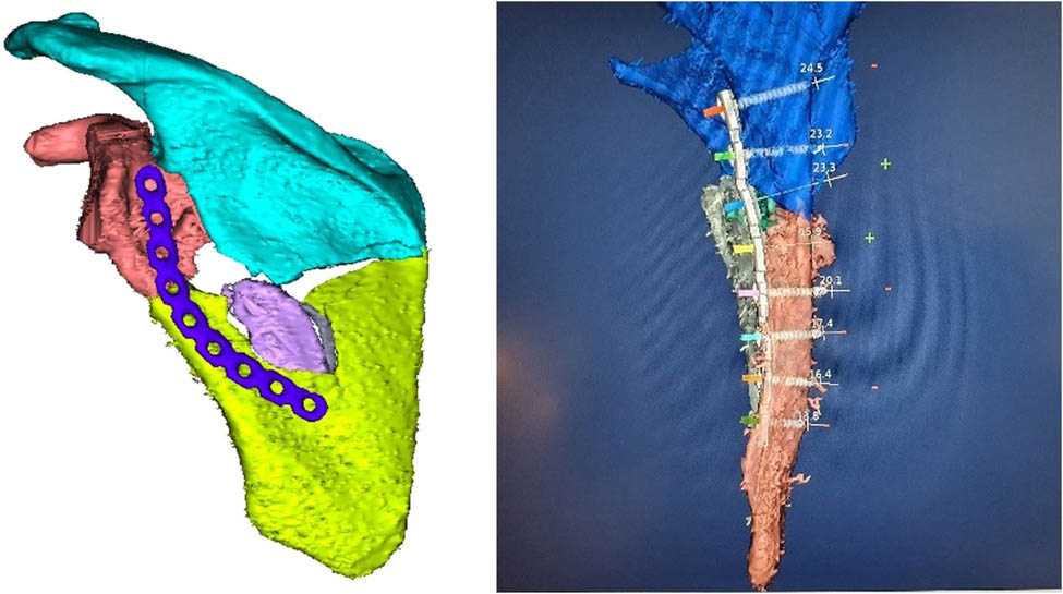 Figure 5
Scapular fracture after the reduction in the TraumaTech software, including optimizing of the implant shape (left) and modeling of the fixation screws (right).