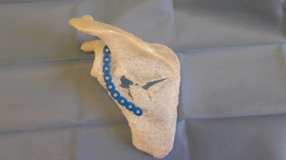 Figure 6
3D print of the scapula model and the implant.