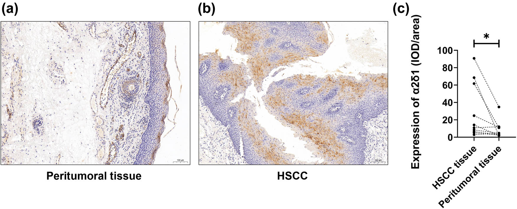 Figure 1 
                  Expression level of α2δ1 in hypopharyngeal squamous cell carcinoma (HSCC) and paired peritumoral mucosal tissues. Expression of α2δ1 in (a) paired peritumoral tissue (100×) and (b) HSCC tissue (100×). (c) Expression level of α2δ1 was significantly increased in paired peritumoral tissue than those in HSCC tissues (n = 10, P = 0.0359).
               