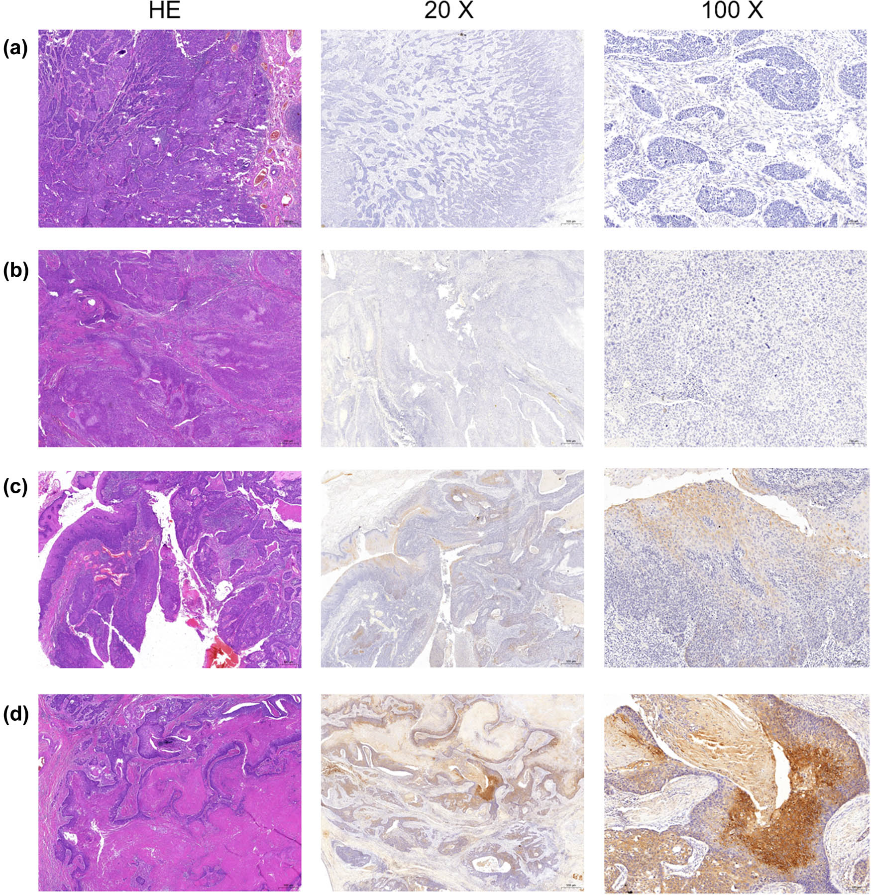 Figure S1 The expression of α2δ1 was variable among HSCC samples. The histological images of 4 representative cases (a–d) were presented. For each case, the HE staining section and immunohistochemistry staining of α2δ1 with different magnifications (20× and 100×) were shown. The expression of α2δ1 varied greatly among these 4 HSCC samples.
