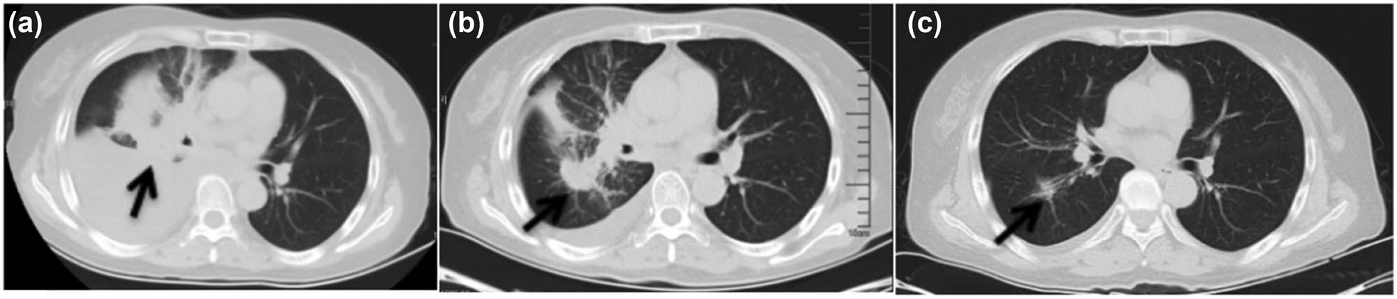Figure 1
Chest CT. The arrow points to the tumor site. (a) At initial diagnosis, (b) after closed drainage of the right chest, and (c) after targeted therapy of gefitinib.