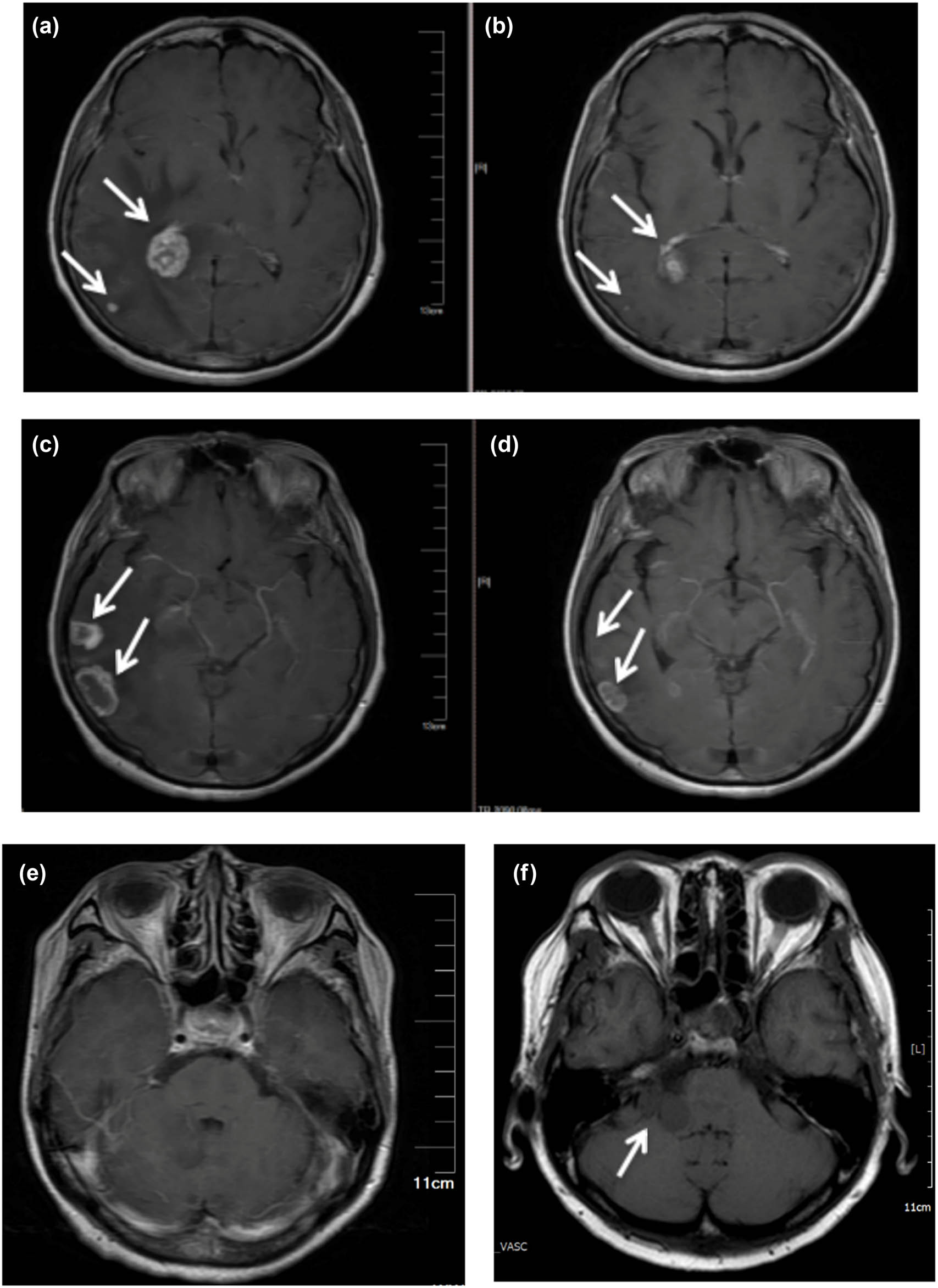 Figure 2
Multiple BMs revealed by MRI. (a and b), (c and d), and (e and f) are image comparison of the same part, respectively. (a), (c), and (e) At initial visit, (b) and (d) after targeted therapy of gefitinib, and (f) a new metastasis was found in the right cerebellar hemisphere.