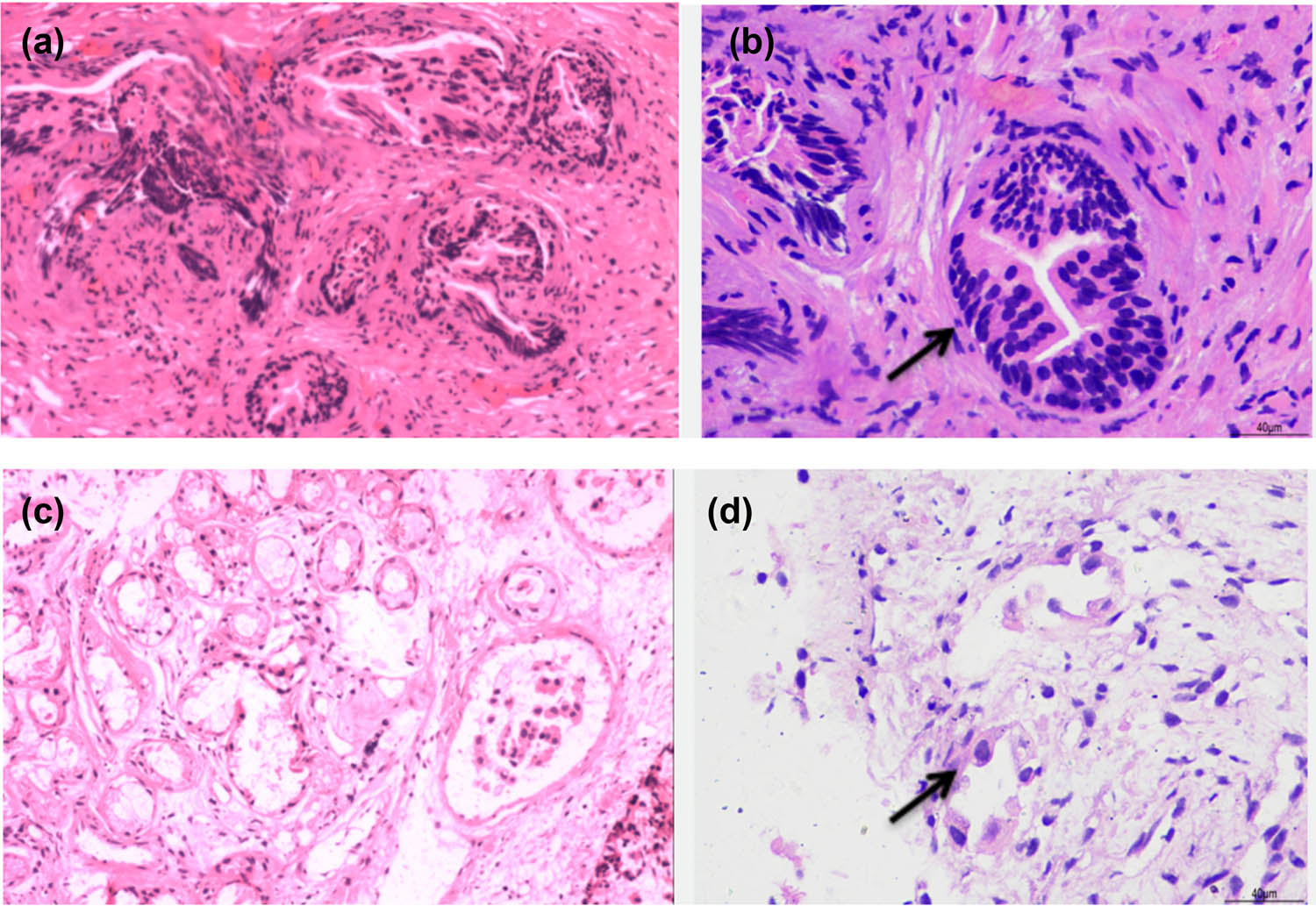 Figure 3
Hematoxylin–eosin-stained biopsy specimens. (a) (10*10) and (b) (40*10) showed the pathology of pleural biopsy specimens: Well-differentiated adenocarcinoma infiltration in small fibrous tissue, immunohistochemical feature: CK (+) EMA (−) Vim (−) MC (−) CR (−) P53 (−) Ki-67 (2% +) CK7 (−) TTF-1 (−) Villin (−) CK 20 (−) CDX-2 (−) CEA (−). (c) (10*10) and (d) (40*10) showed the pathology of bronchoscopic biopsy specimens: (right lower lobe bronchial orifice) infiltrating adenocarcinoma, tumor thrombus was found in vascular cavity, immunohistochemical feature CK7 (+) TTF-1 (+) CEA (+) CK (+) CD31 (vascular+, tumor thrombus visible).
