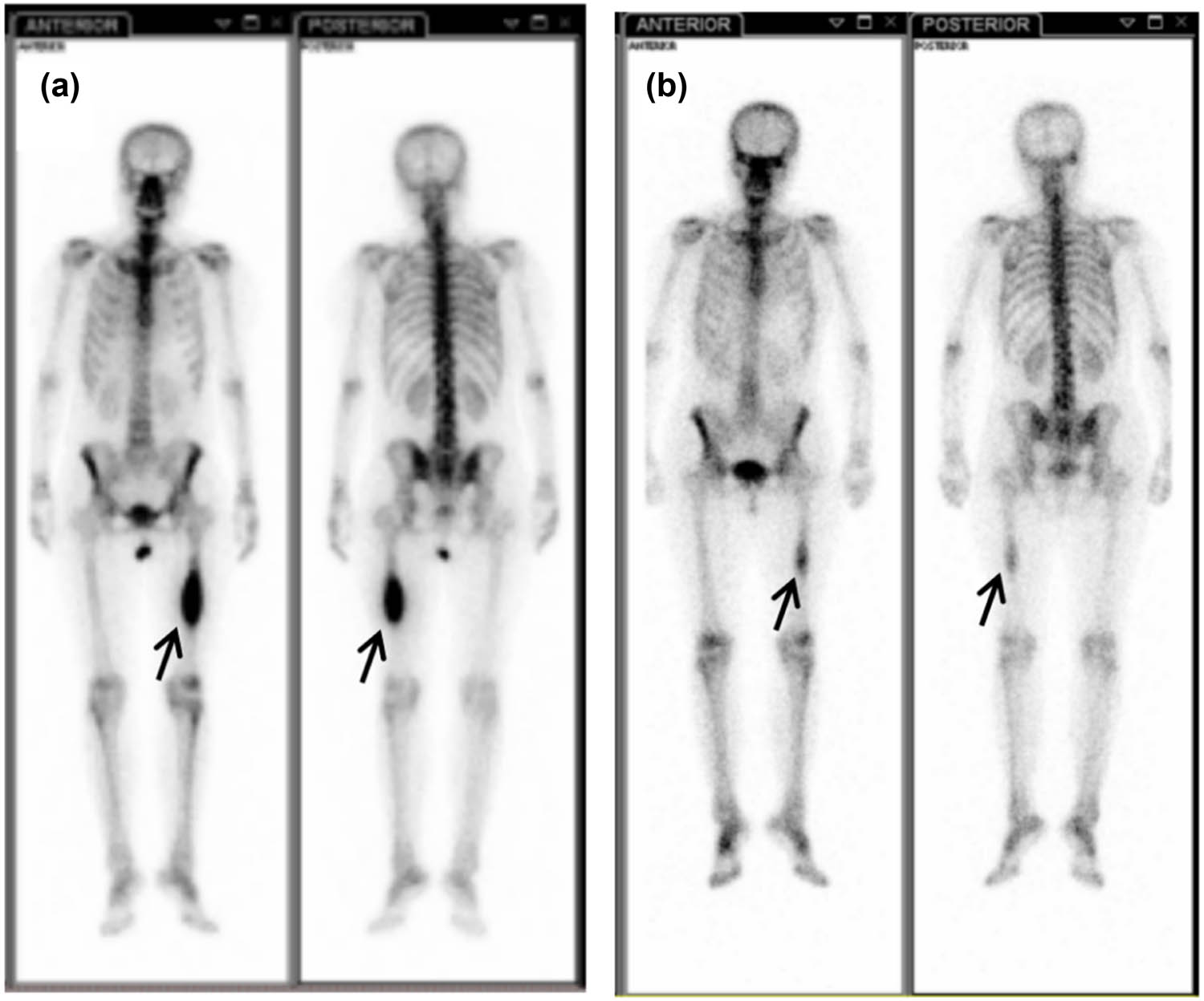 Figure 4
Systemic bone imaging. The metabolic activity of hypermetabolic focus in the middle part of left femur decreased significantly after treatment. (a) At the initial visit and (b) after targeted treatment of gefitinib.