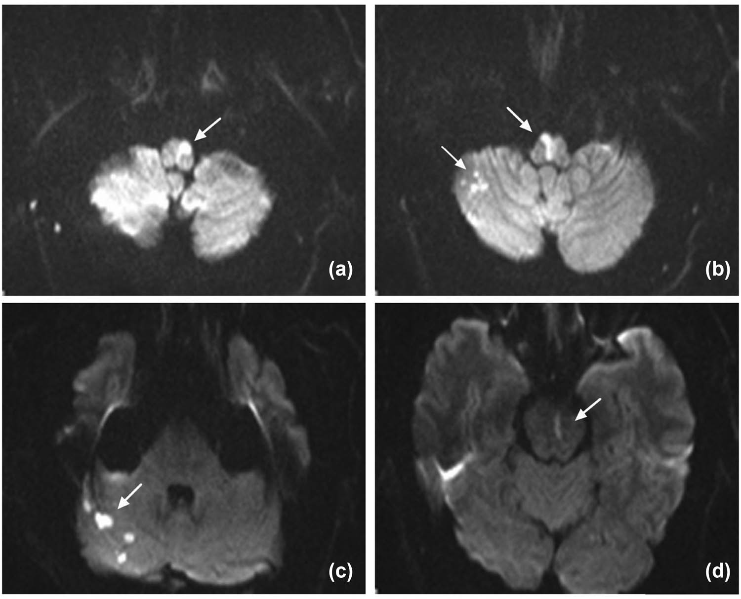 Figure 1 
               (Axial DWI imaging): (a and b; arrow) bilateral medial medullary infarction involves the ventral, middle parts of the medulla oblongata, which were compatible with atypical “heart appearance.” (b and c) The right cerebellar hemisphere and (d) pons also showed high-intensity lesions.
            