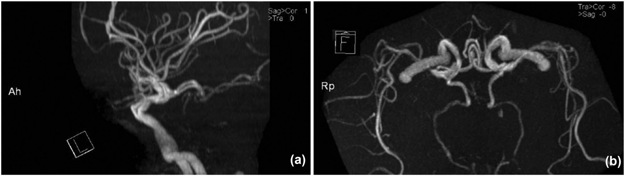 Figure 2 
               (TOF-MRA imaging): the lateral projection of an MRA image shows the hypoplastic BAS. (a and b) The posterior communicating arteries supply the territory of all branches of the PCAs, which were considered as fetal-type. (b) Caudocranial projection image shows that both PCAs were divided from ICA separately.
            