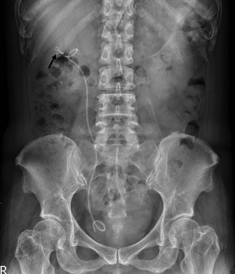 Figure 1 
               Post-PCND follow-up KUB show a new radiopaque lesion (arrow) in right kidney area.
            