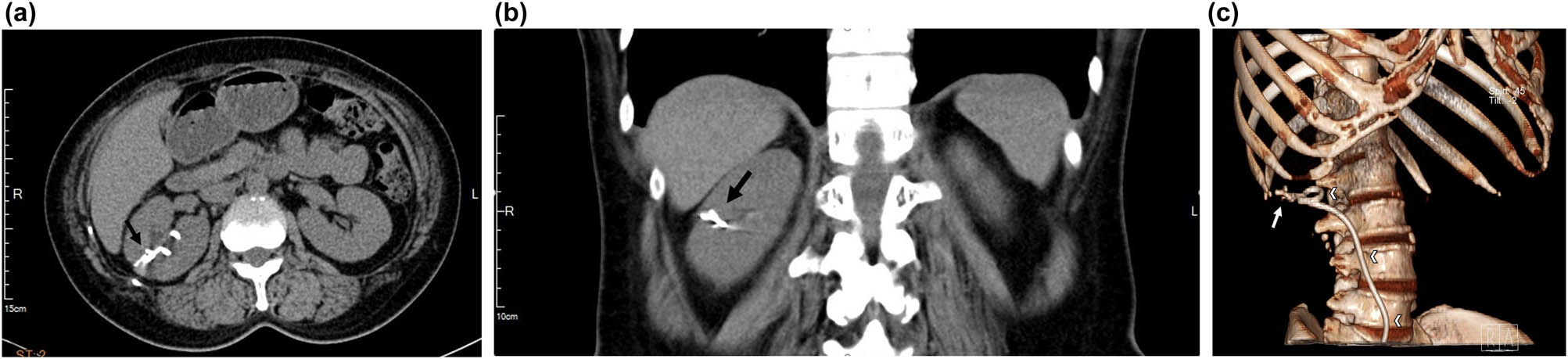 Figure 2 
               Computed tomography image of the intrarenal foreign body (arrow) and its relationship with right double J ureter stent (arrowheads). (a) Transverse cut, (b) coronal cut, and (c) reconstruction.
            