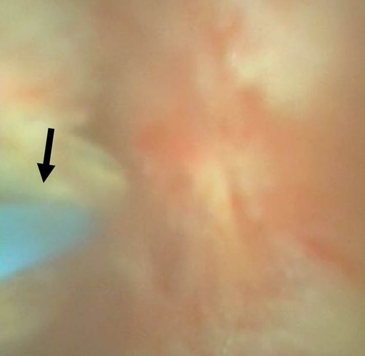 Figure 3 
               The video image of fURS and the laser probe (arrow) for cutting the underlying renal parenchyma for exposure of the embedded material.
            