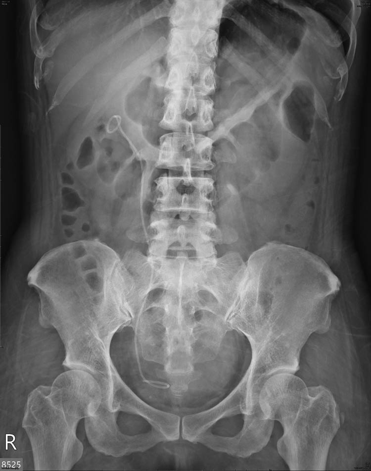 Figure 6 
               Postoperative KUB showed disappearance of the radiopaque lesion at right kidney area. Right double J ureteral stent were in situ.
            