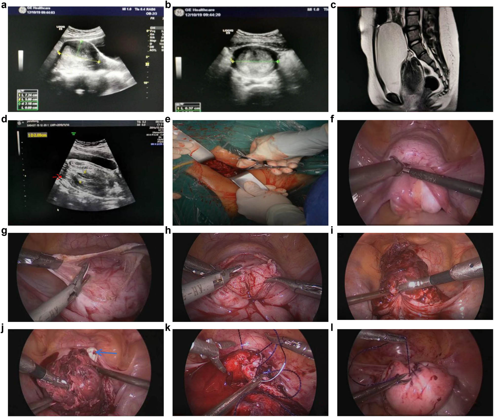 Figure 1
(a and b) Color ultrasound images (sagittal and transverse position) 10 days before the surgery. (c) MRI image after admission. (d) Color ultrasound image after admission (the arrow points to the ovary). (e) Intraoperative vaginal view. (f) Intraoperative laparoscopic view. (g) The uterine serosa was incised. (h) The anterior myometrium and the vagina were incised. (i and j) Uterus after incision (the blue arrow indicates the finger of the vaginal operator). (k) Suturing the vagina and the myometrium. (l) Uterus at the end of suturing.
