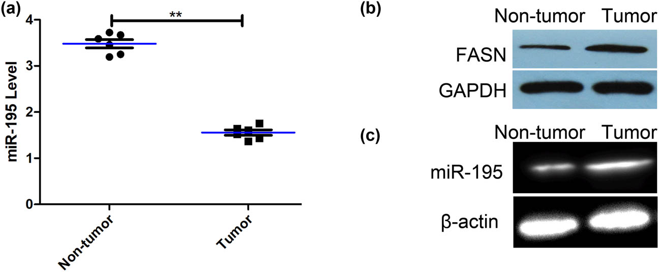 Figure 1 
                  The expression of miR-195 and its methylation level in the osteosarcoma tissues. (a) The expression of miR-195 of fresh osteosarcoma tissues was significantly lower than that of fresh normal bone tissue (n = 6; p < 0.001). The error bar represents the standard variation of the miR-195 levels in patients with or without osteosarcoma. (b) The western blot assay showed that the expression of FASN of fresh osteosarcoma tissues was significantly higher than that of fresh normal bone tissues (n = 6). (c) MSP assay showed that the methylation levels of promoter regions of miR-195 in osteosarcoma tissues were significantly higher than that in fresh normal bone tissues (n = 6). *p < 0.05, **p < 0.01, n = 6/group.
               