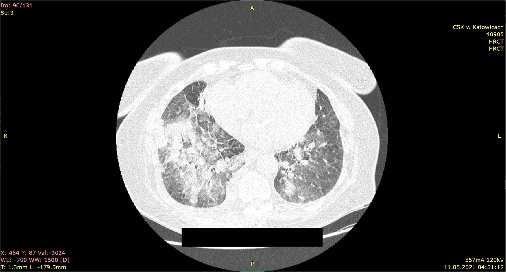 Figure 1 
               HRCT scans on hospital admission: bilateral, superimposed air space consolidations with GGO in lower and upper lobes, more marked on right are described.
            
