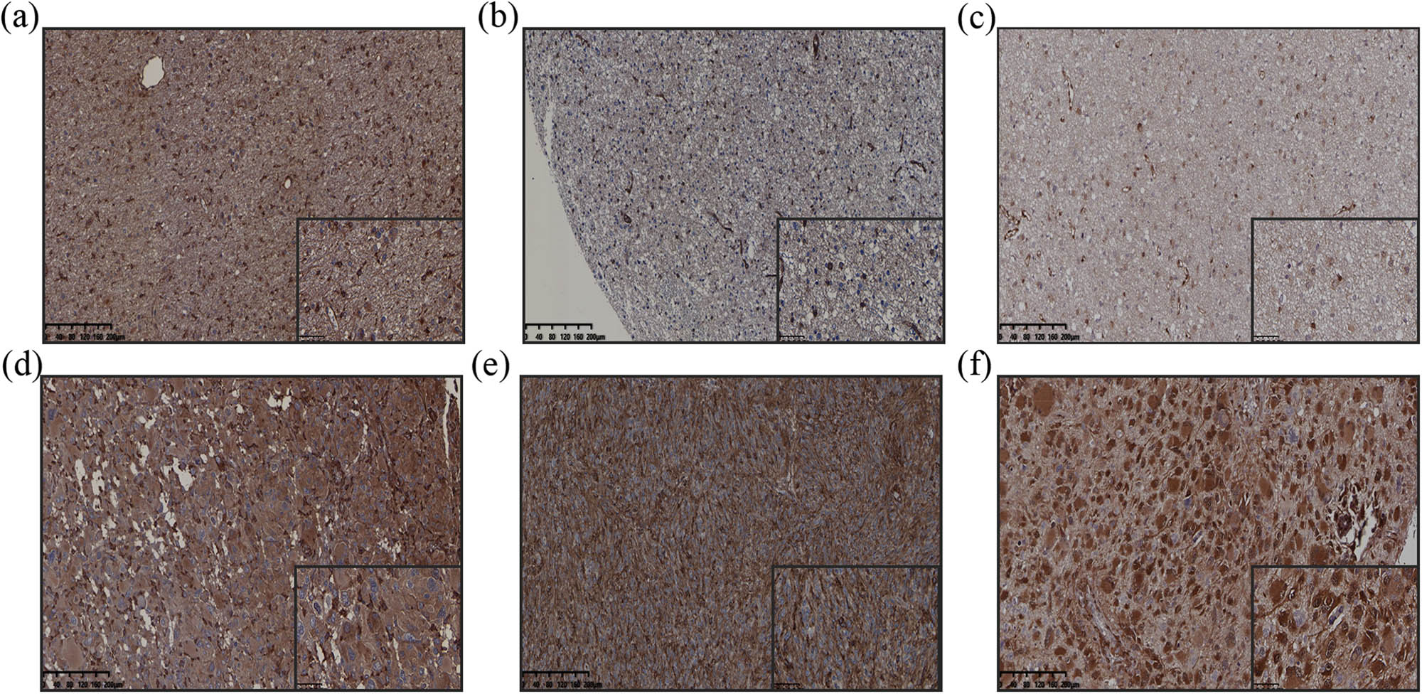 Figure 4
Immunohistochemistry analysis of MT1-MMP, β1-integrin and YAP1 expression in glioma tissues. (a) MT1-MMP expression in LGG (200×). (b) β1-integrin expression in LGG (200×). (c) YAP1 expression in LGG (200×). (d) MT1-MMP expression in GBM (200×). (e) β1-integrin expression in GBM (200×). (f) YAP1 expression in GBM (200×). GBM, glioblastomas; LGG, lower-grade gliomas.