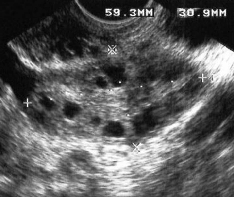 Figure 1 
               Transverse US image of the left ovary demonstrates the “string of pearls” sign.