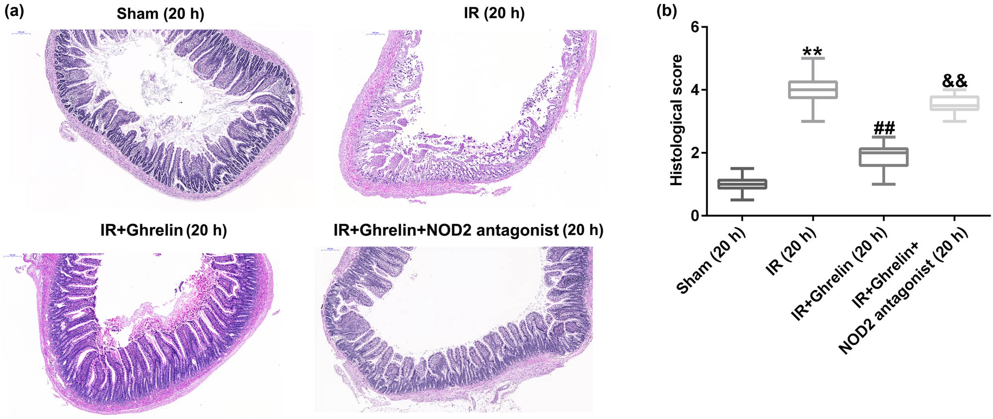 Figure 1 
                  NOD2 antagonist reversed the effects of ghrelin on small bowel tissue injury. Rats were euthanized at either 4 or 20 h after treatment, and their small intestine tissue samples were obtained. (a) Representative intestinal sections from rats of different groups were stained with hematoxylin and eosin. The epithelial structure was clearly demarcated in the sham group. More serious mucosal damage was found in the I/R group than in the sham group. Ghrelin relieved mucosal injury compared to the I/R group. The NOD2 antagonist aggravated mucosal injury in the I/R group. (b) The histological score was determined. Data were expressed as mean ± SD, n = 6; **P < 0.01 vs sham; ##
                     P < 0.01 vs IR; and P < 0.01 vs IR + ghrelin.
               