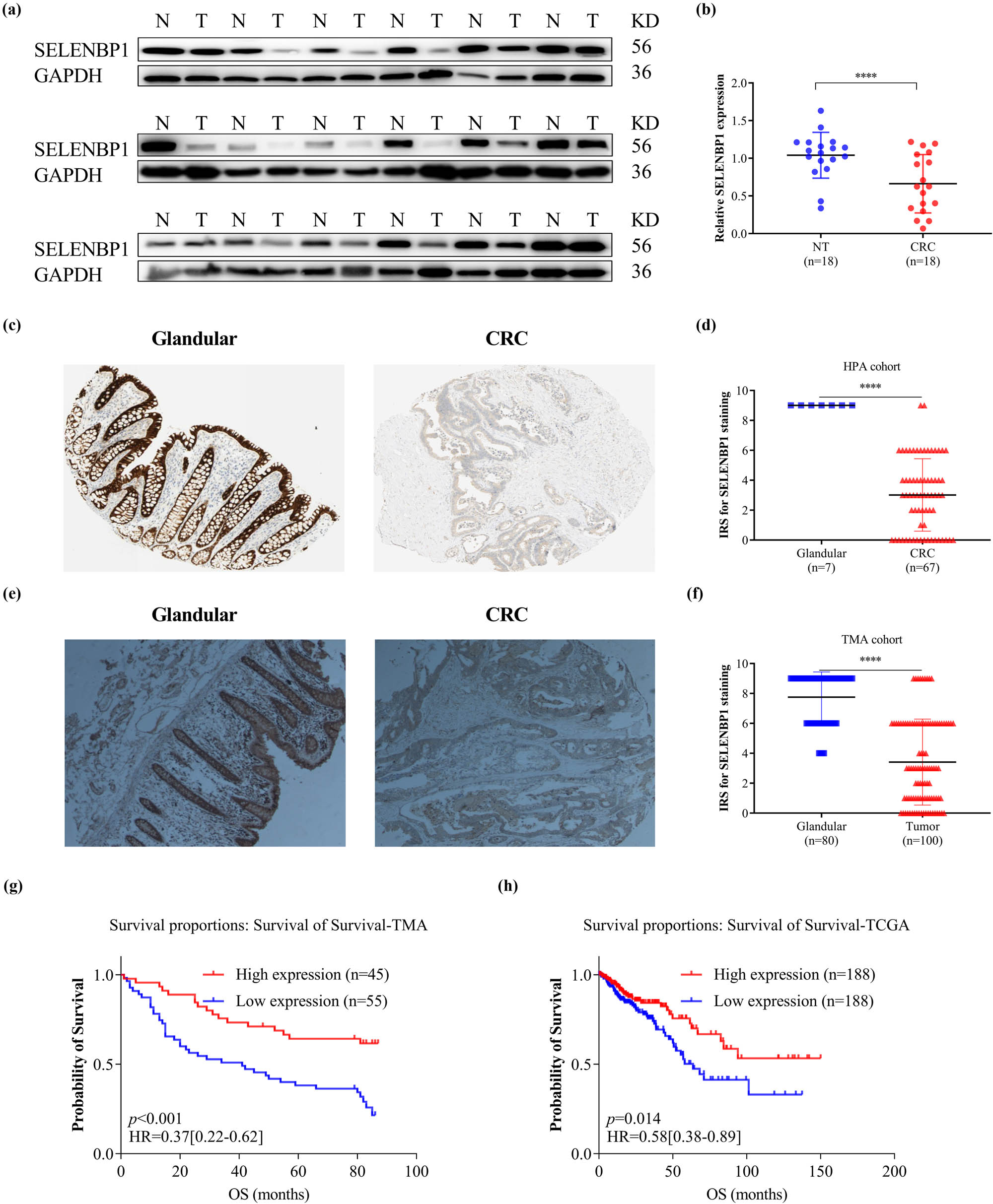Figure 3 
                  Suppressed expression of SELENBP1 in CRCs is associated with poor patient survival. The expression of SELENBP1 protein was detected by WB in 18 pairs of NTs and CRCs (a) and quantified by gray-scale analysis (b). Immunohistochemistry data of SELENBP1 were downloaded from the HPA database and compared between glandular tissues and CRCs using an IRS method (c and d). A TMA consisting of 100 CRCs and 80 NTs was stained with an anti-SELENBP1 antibody (d, 40×) and the IRS was evaluated (f). Kaplan–Meier plots were drawn for OS of patients in the TMA cohort (g) and TCGA cohort (h). Patients were stratified into low and high SELENBP1 expression groups according to SELENBP1 mRNA expression in the TCGA cohort and IRS of SELENBP1 in the TMA cohort (<median vs ≥median). Values of p were obtained using the log-rank test. Censored data are indicated by the + symbol. ***
                     p < 0.001; ****
                     p < 0.0001 vs the control group.
               