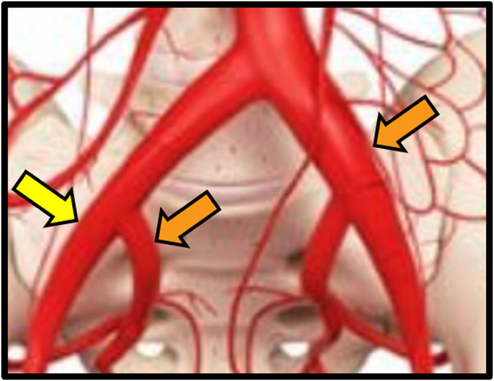 Figure 1 
               Site of UAF. Yellow dart: case 1 (proximal external iliac artery). Orange darts: case 2 (distal left common iliac artery and proximal left hypogastric artery).
            