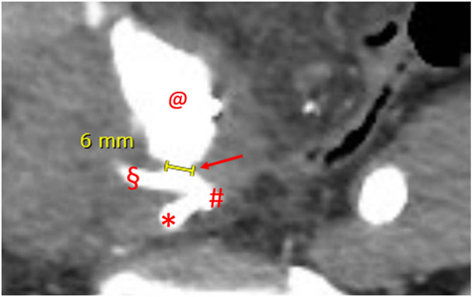 Figure 2 
               Angio-CT, axial plane, arterial phase, case 1. Major diameter of the UAF. Dart: UAF with concomitant iodinated contrast leakage; #: common right iliac artery bifurcation; *: hypogastric artery; §: external iliac artery; and @: pseudoaneurysm sac.
            