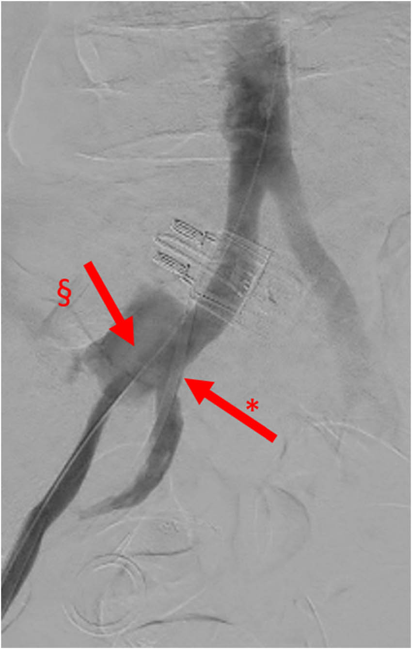Figure 3 
               Angiography, image with no digital subtraction, frontal view, late arterial phase, case 1. Iodinated contrast leakage from UAF. *: right ureteral double J stent and §: contrast leakage from UAF.
            