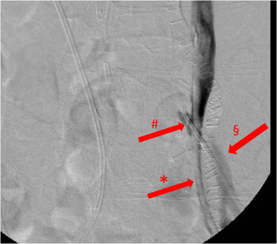 Figure 4 
               Retrograde ureterography, image with no digital subtraction, frontal view, case 2, first episode. Iodinated contrast leak from the left ureter into the distal left common iliac artery. *: left ureteral stent; §: left common iliac artery; and #: UAF.
            