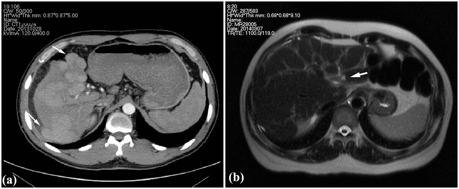 Figure 1 
                  Images of clinical cases. (a) Enhancement CT showing the multiple intrahepatic nodules protruded from the liver surface (arrow) in Case 1 and (b) T2WI of MR showing heterogeneous fibrosis and a nodule in the left inner lobe (arrow) in Case 2.
               