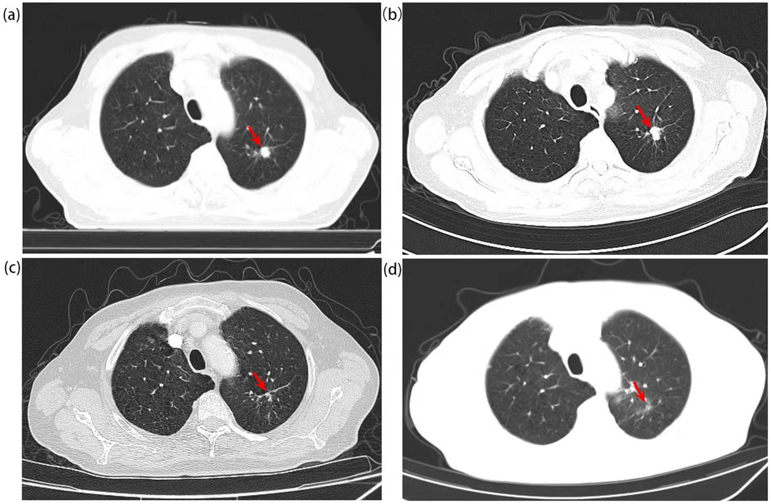 Figure 2 
               The CT scan of the chest shows the lung carcinoma: (a) shows a nodular hyperdense shadow seen in the posterior segment of the left upper lobe of the lung with medium contrast in August 2020 (with a size about 11 mm × 12 mm). (b) Shows the lesion before chemotherapy plus immunotherapy against PD-1. (c) Shows that the lesion was significantly reduced after two cycles of chemotherapy plus immunotherapy against PD-1. (d) Shows that the lesion almost disappeared after radiotherapy.
            