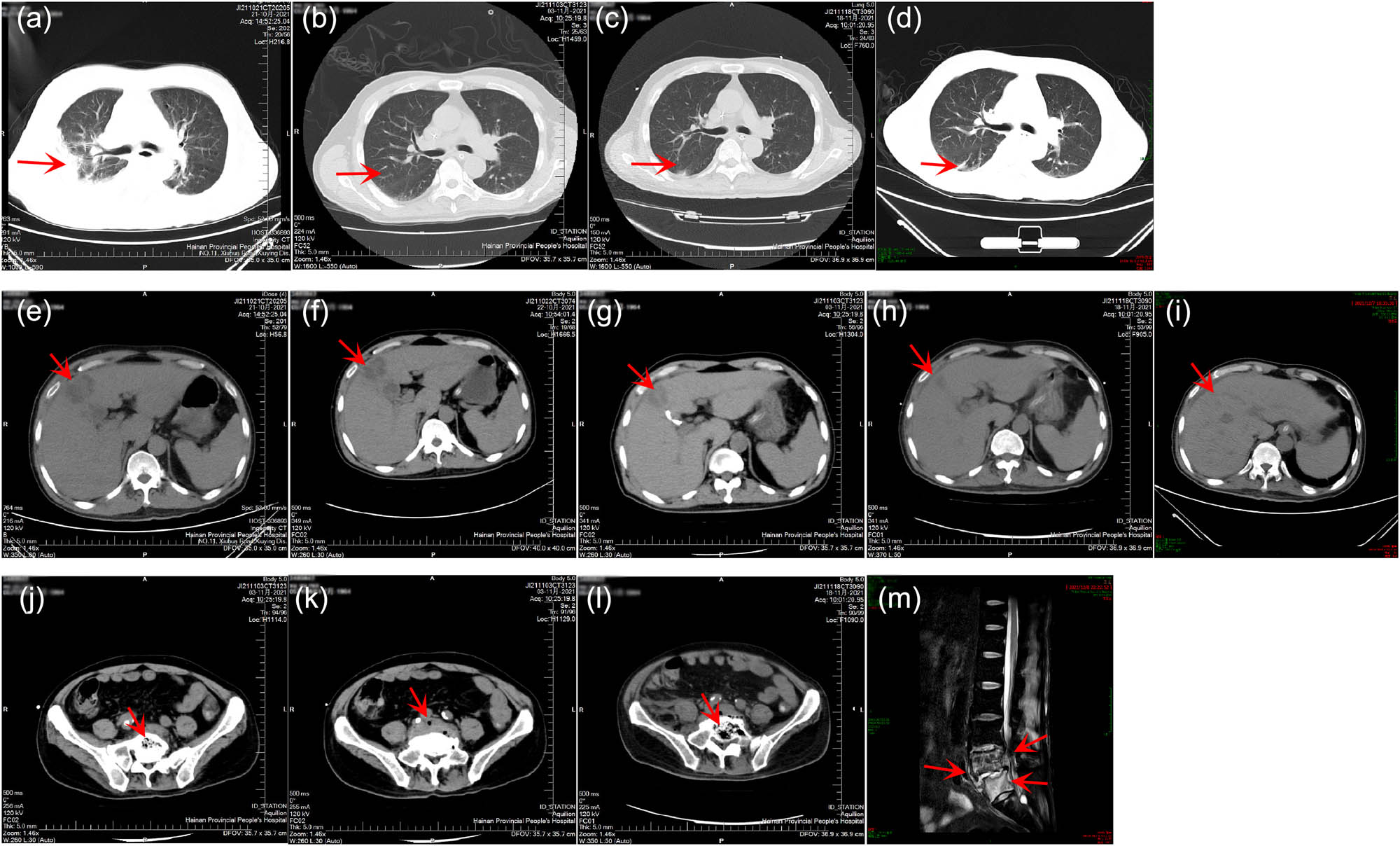 Figure 2 
               Imaging test results of the patient. (a)–(d) Lung CT results on October 21 (Day 1), November 3 (Day 14), November 18 (Day 29), and December 7 (Day 48), respectively. (e)–(i) Liver CT results on October 21 (Day 1), October 22 (Day 2), November 3 (Day 14), November 18 (Day 29), and December 7 (Day 48), respectively. (j) and (k) Abdominal CT results on November 3 (Day 14). (l) Abdominal CT results on November 18 (Day 29). (m) Lumbar MRI results on December 8 (Day 49).
            