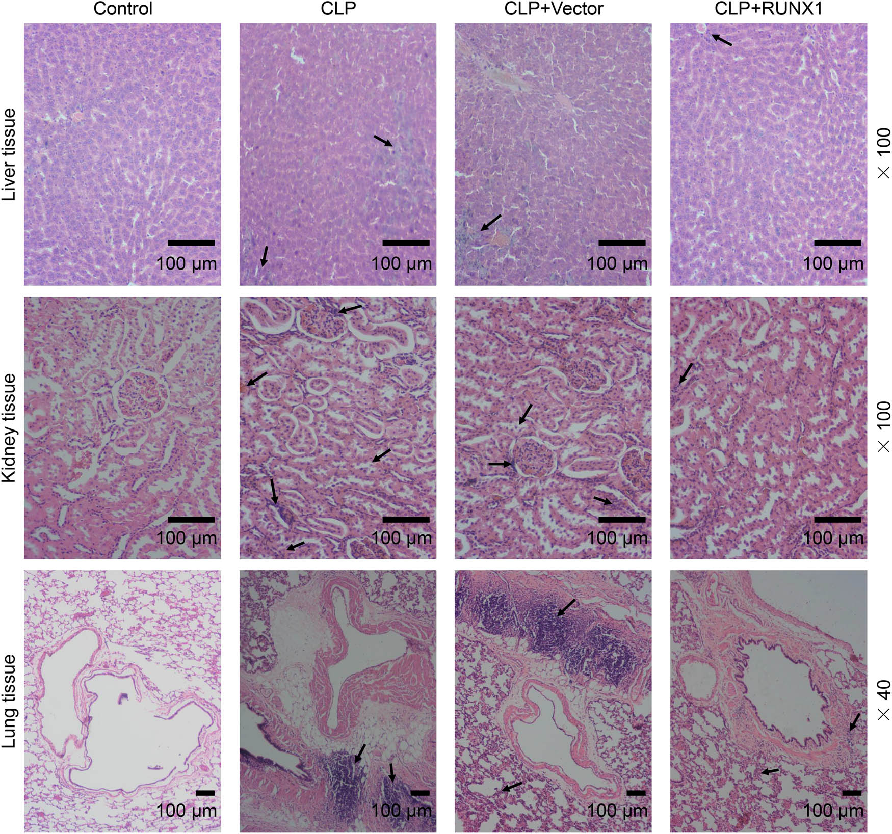 Figure 3 
                  RUNX1 overexpression alleviated liver, kidney, and lung injury in CLP mice. The effect of overexpressed RUNX1 on liver, kidney, and lung injury in CLP mice was examined by H&E staining (100×, 40×, 100 μm). Infiltration of inflammatory cells and the damaged sites are indicated by arrows.
               