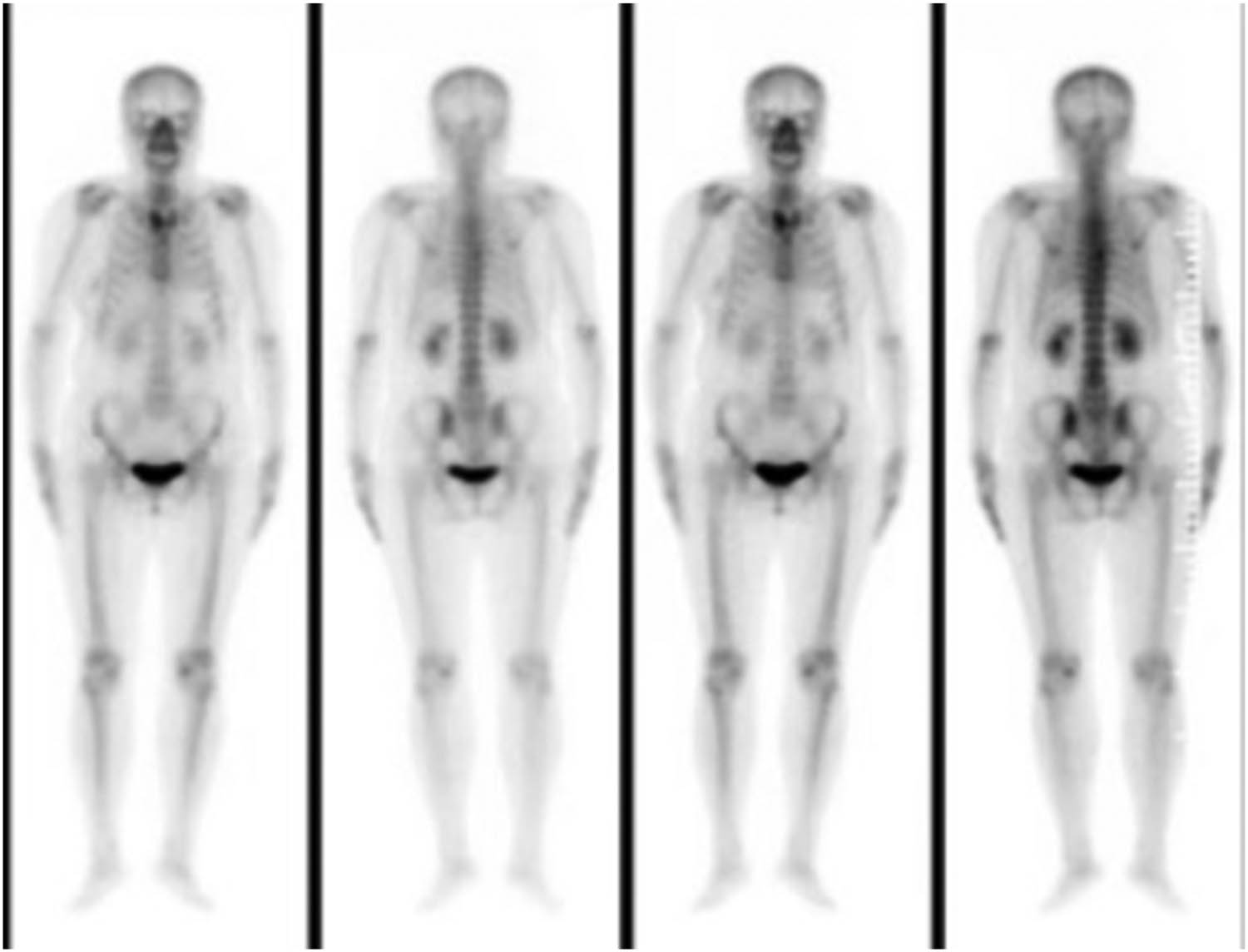 Figure 2 
               Bone scan showed diffuse increased uptake of the isotope at the level of the right transverse process of T7.
            