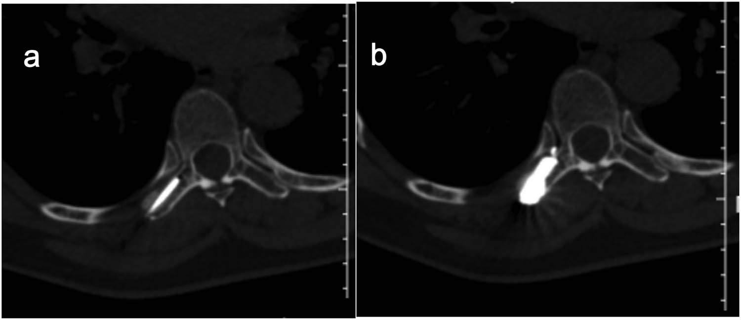 Figure 4 
               On control CT scan performed during MWA (a) and bone cement was injected into the lesion during the operation (b).
            