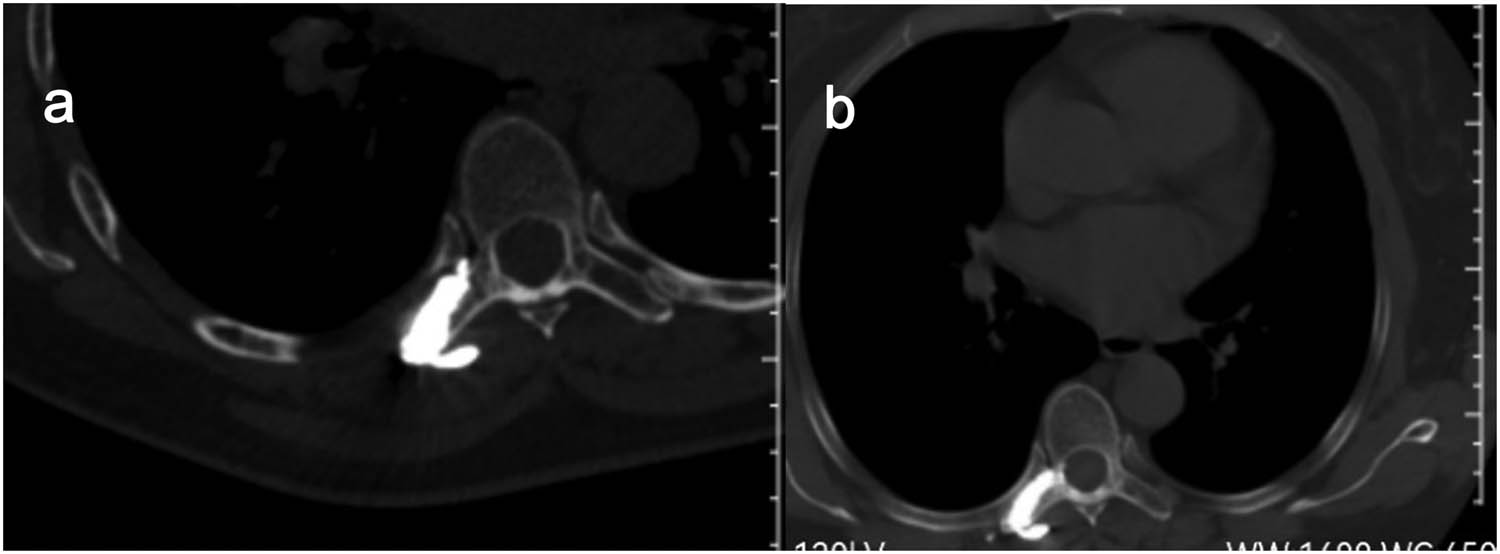 Figure 5 
               Postoperative CT showed intact cement filling and no leakage in the spinal canal (a) and follow-up after 6 months showed no displacement of the bone cement and no new bone destruction (b).
            